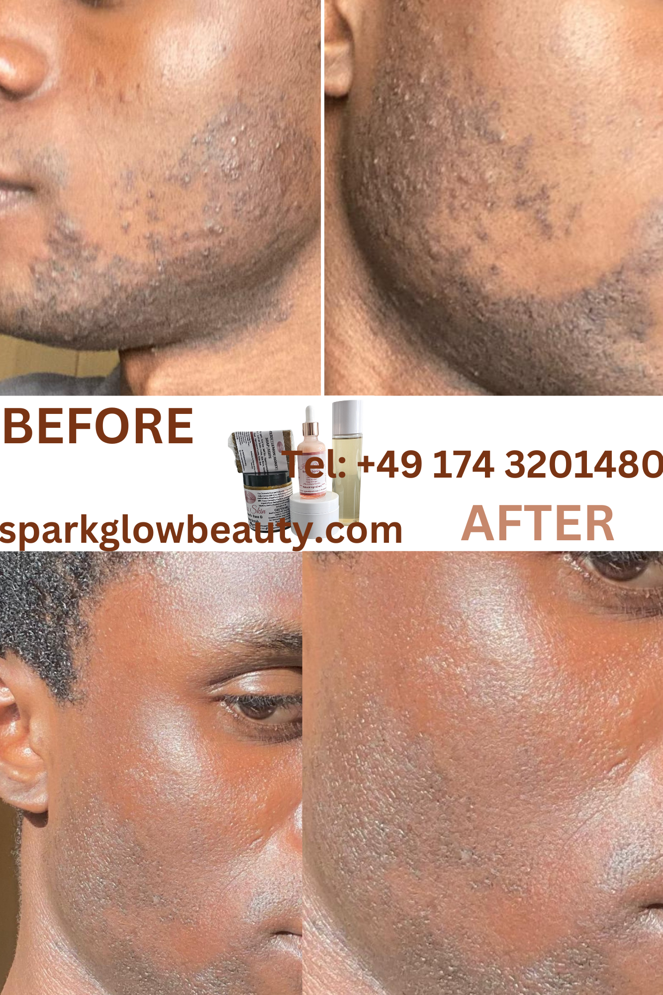 ACNE & PIMPLES TREATMENT SET